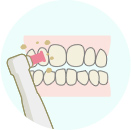 歯のクリーニング歯垢・歯石の除去