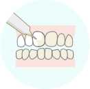 歯の表面にジェルを塗布