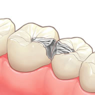 メタルインレー（保険適用）