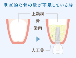 サイナスリフト法(上顎洞挙上術)